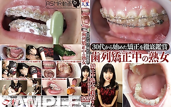 30代から始めた矯正を徹底鑑賞！歯列矯正中の熟女
